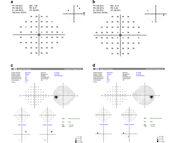 Visual Field Analyzer